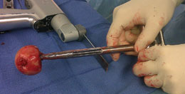 Expanding Cannulated Corkscrew Femoral Head Remover