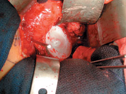 Minimally Invasive Total Hip Surgery Retractors