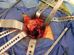 Minimally Invasive Total Hip Surgery Retractors