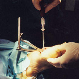 O'Brien Clamp in Surgery