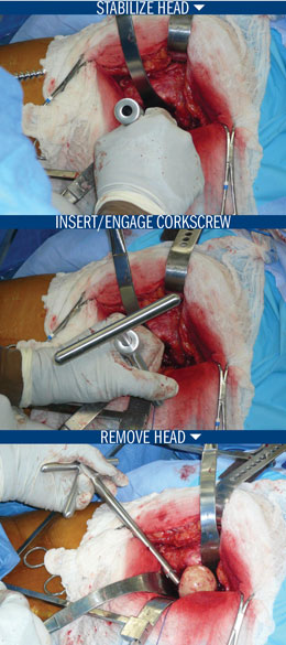 Rivero Anti-Rotation Corkscrew Femoral Head Remover