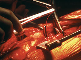 Incavo Wire Passer in Surgery