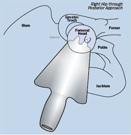 Femoral Elevator with Trough