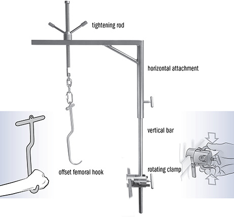 Wixson Anterior Suspension Hook System