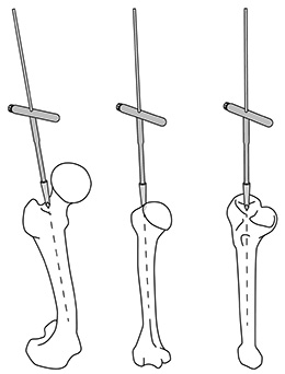 Chaudhari Universal Nail Entry Guide