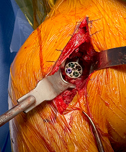 Dillon Curved Glenoid Retractors