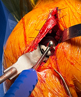 Dillon Curved Glenoid Retractors