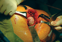 Gordon Femoral Elevator