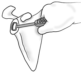 Lipof Glenoid Cartilage Curette