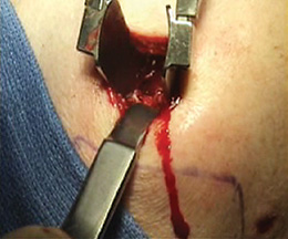 Rotator Cuff Advancer
